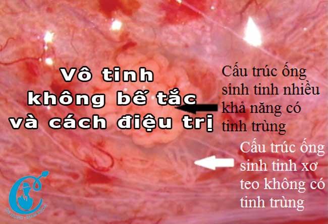 Vô tinh không bế tắc là gì? Phương pháp điều trị vô tinh không bế tắc