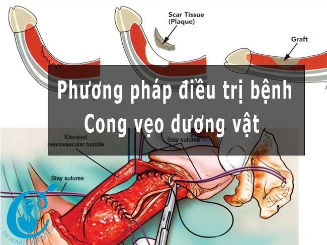 Các phương pháp điều trị bệnh cong vẹo dương vật