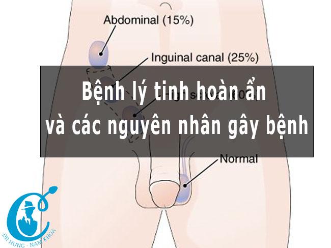 Phương pháp điều trị bệnh tinh hoàn ẩn
