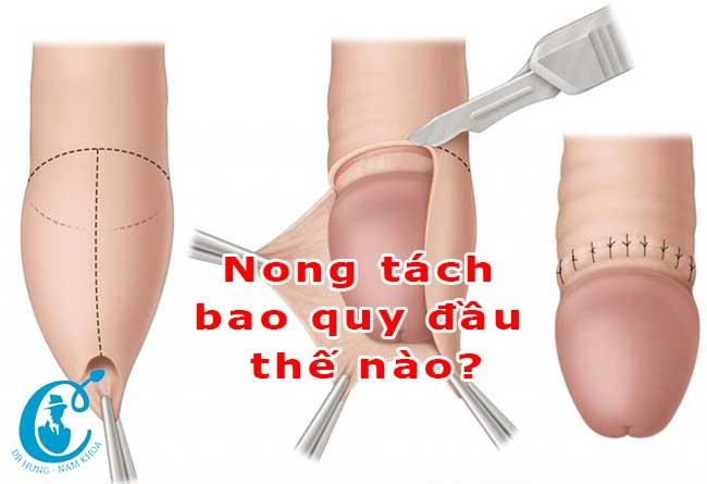 Quy trình nong tách bao quy đầu cho người có bao quy đầu bị dính hoặc bị hẹp