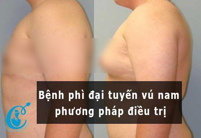 Phì đại tuyến vú ở nam giới, nguyên nhân và cách điều trị hiệu quả