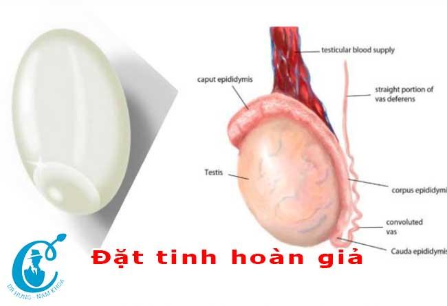 Đặt tinh hoàn giả là gì? Những ai nên đặt tinh hoàng giả?