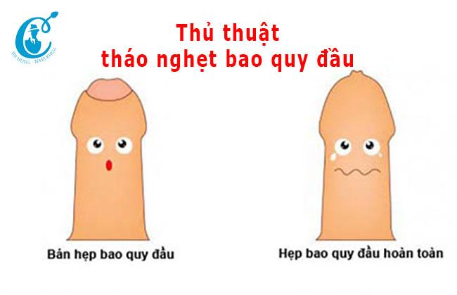 Thủ thuật tháo nghẹt bao quy đầu cho bệnh nhân