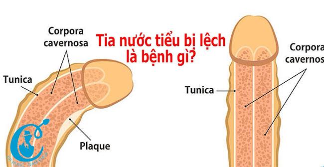 Khi đi vệ sinh tia nước tiểu bị lệch là bệnh gì?