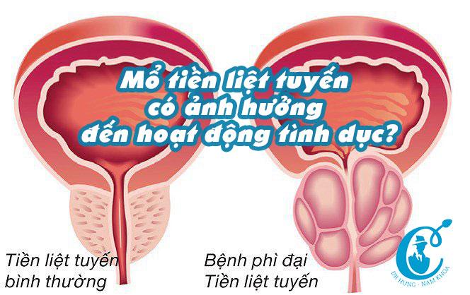 Mổ tiền liệt tuyến có ảnh hưởng đến hoạt động tình dục?
