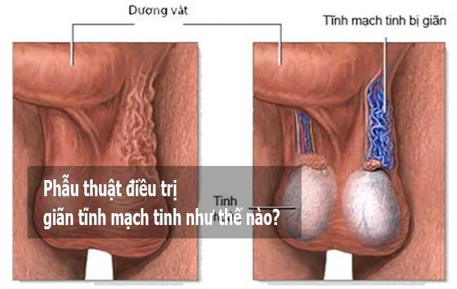 Phẫu thuật điều trị giãn tĩnh mạch tinh