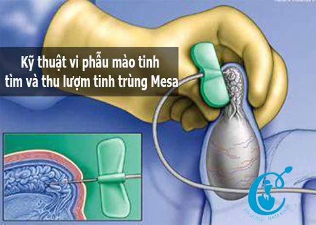 Kỹ thuật vi phẫu mào tinh tìm và thu lượm tinh trùng Mesa