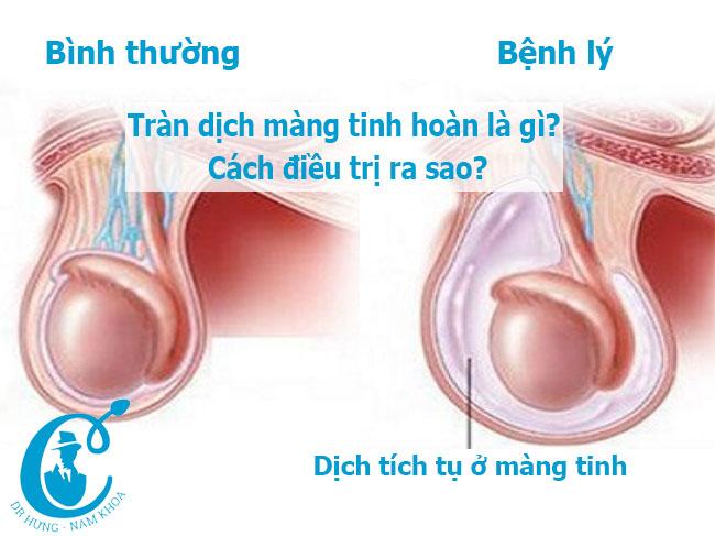 Tràn dịch màng tinh hoàn là gì? Cách điều trị ra sao?