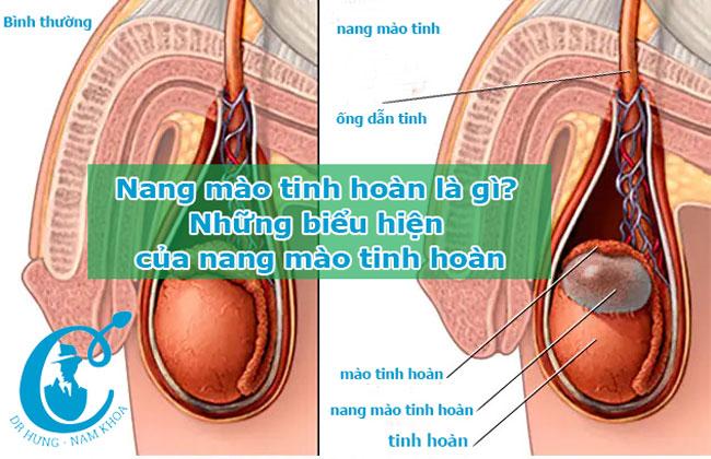 Nang mào tinh hoàn là gì? Nhưng biểu hiện của nang mào tinh hoàn