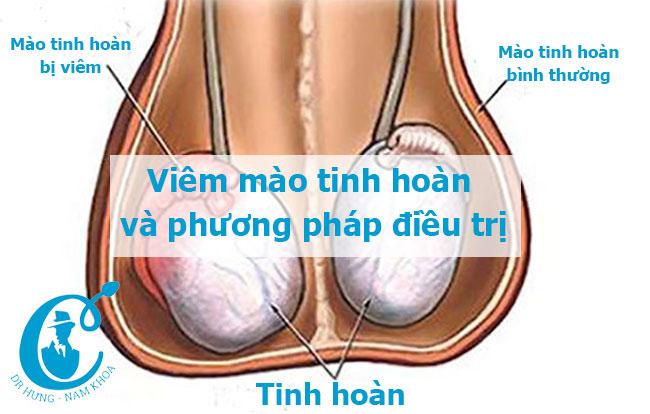 Viêm mào tinh hoàn và phương pháp điều trị