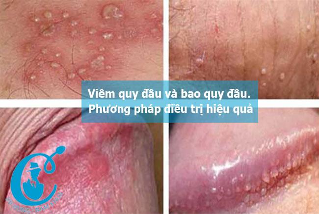 Viêm quy đầu và bao quy đầu. Phương pháp điều trị hiệu quả