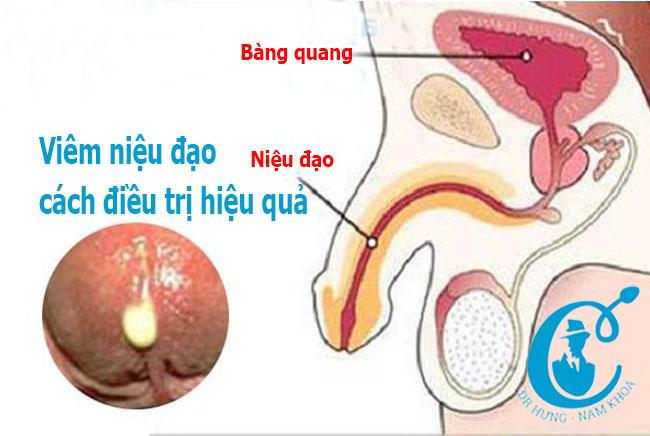 Viêm niệu đạo là gì? Có nguy hiểm không?