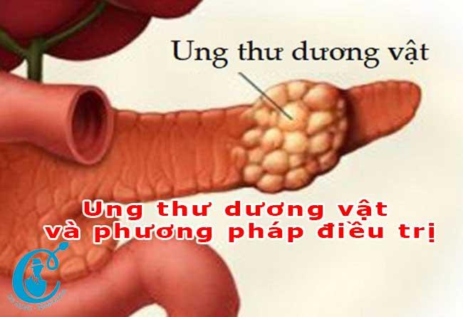 Chẩn đoán ung thư dương vật và phương pháp điều trị