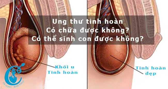 Ung thư tinh hoàn và các triệu chứng của ung thư tinh hoàn