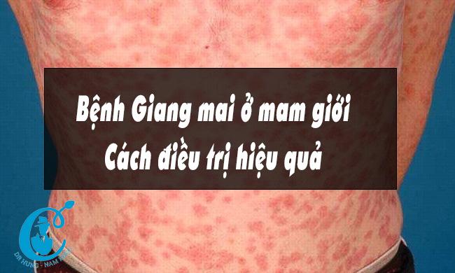 Bênh giang mai là gì? Điều trị bệnh giang mai ra sao?