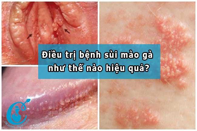 Chẩn đoán và cách điều rị bệnh sùi mào gà