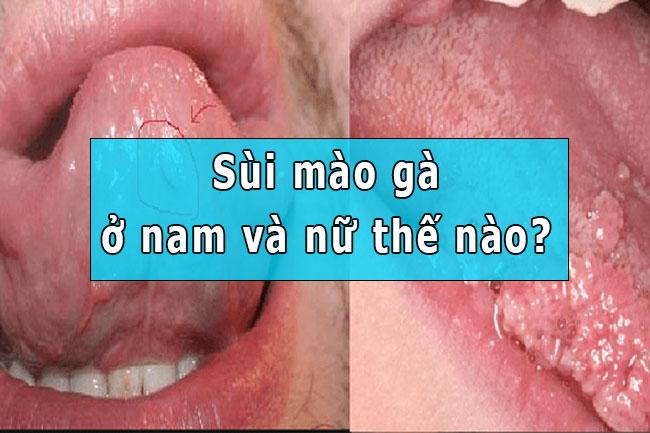 Bệnh sùi mào gà và những biểu hiện của bệnh sùi mào gà