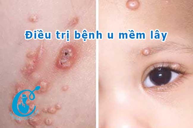 Bệnh u mềm lây và phương pháp điều trị bệnh u mềm lây