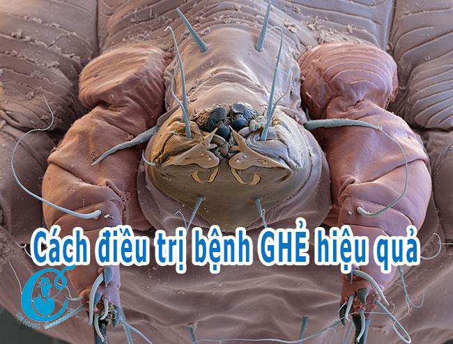 Những biểu hiện của bệnh ghẻ và cách điều trị hiệu quả