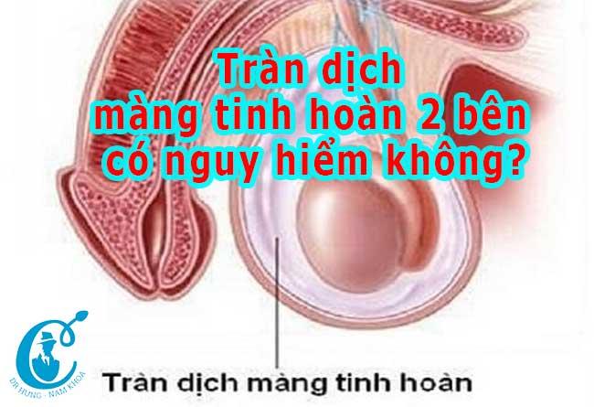 Tràn dịch màng tinh hoàn 2 bên có nguy hiểm không?
