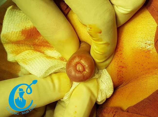 Nên đi nong tách khi bị hẹp bao quy đầu từ nhỏ