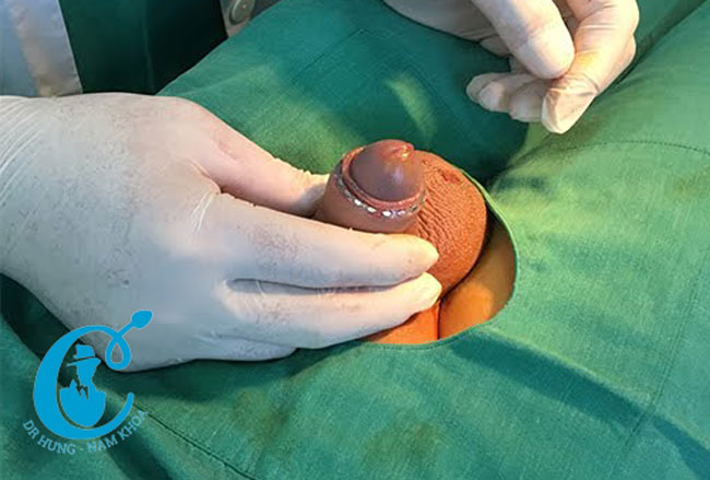 Thủ thuật tháo nghẹt bao quy đầu