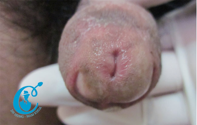 Trường hợp bị dinh bao quy đầu ở người lớn