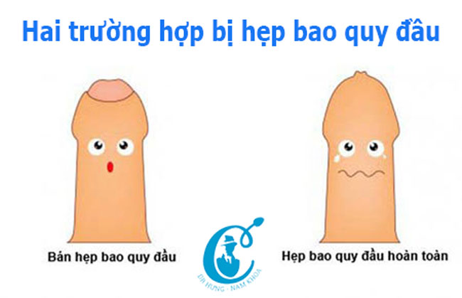 Các trường hợp bị hẹp bao quy đầu.jpg