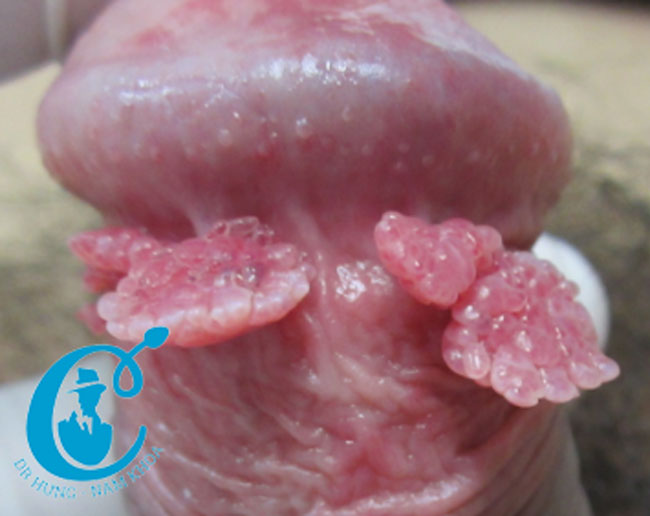 Sùi thể phẳng dày đặc ở rãnh quy đầu, phanh hãm, bao quy đầu và quy đầu