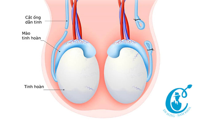 Thắt ống dẫn tinh không ảnh hưởng đến sức khỏe tình dục