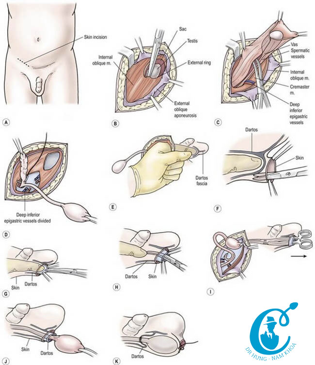 Quy trình phẫu thuật hạ tinh hoàn