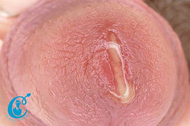 Điều trị bệnh Chlamydia như thế nào hiệu quả?