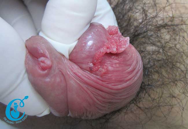 Hình 2: Sùi mào gà điển hình cả trong lỗ đái và rãnh quy đầu