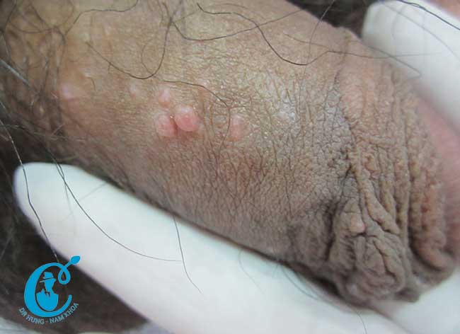 Hình ảnh tổn thương do bệnh u mềm lây ở dương vật