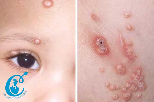 Hình ảnh tổn thương do bệnh u mềm lây ở trẻ