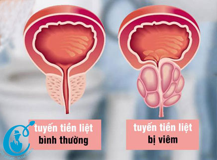 HÌnh ảnh tiền liệt tuyến bình thường và tiền liệt tuyến bị viêm