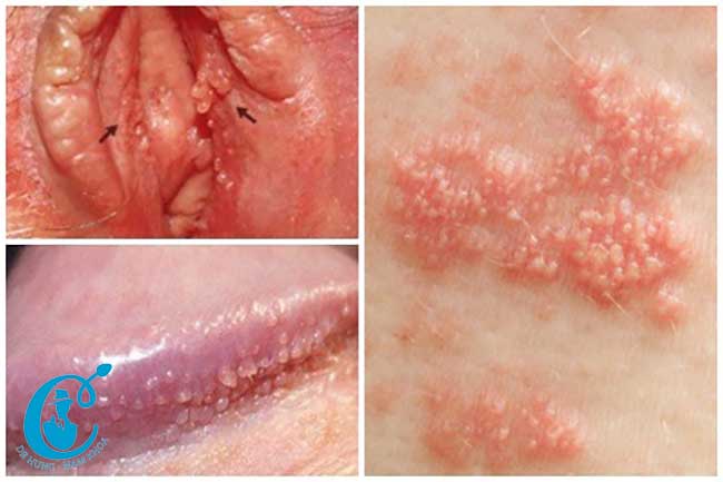Một số biểu hiện điển hình của bệnh sùi mào gà