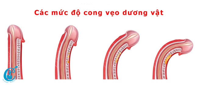 Các mức độ cong vẹo dương vật