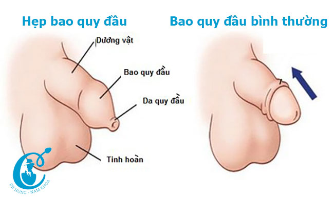 Hình ảnh bao quy đầu bị hẹp và bao quy đầu bình thường