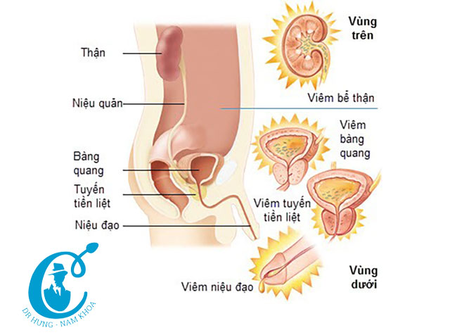 Viêm niệu đạo gây đái buốt rất khó chịu