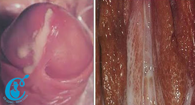 Dấu hiệu tổn thương do bệnh Chlamydia gây ra ở bộ phận dinh dục Nam và Nữ