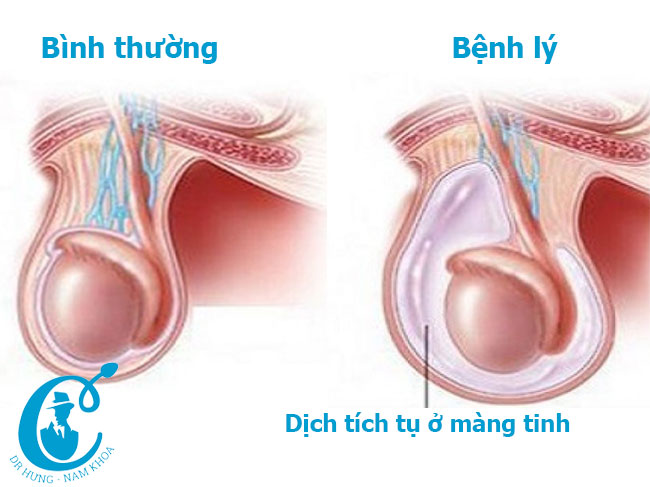 Dịch tích tụ ở màng tinh dẫn đến bìu bị phồng to 