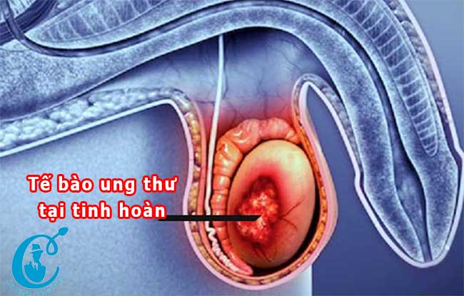 Điều trị ung thư tinh hoàn có tỷ lệ khỏi bênh lêndđến 95%