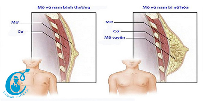 Nam giới có tuyến vú bình thường và bị phì tuyến vú