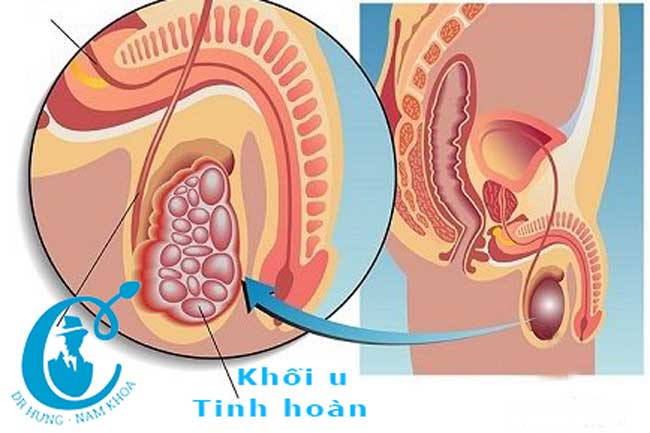 Khối u ở tinh hoàn