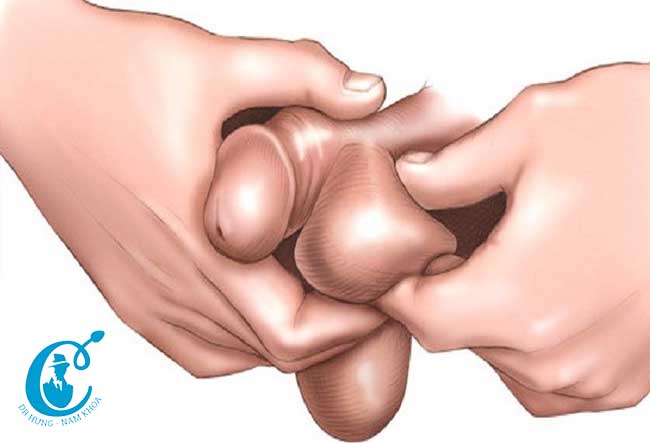 Thường xuyên tự khám kiểm tra để sớm phát hiện ung thư tinh hoàn