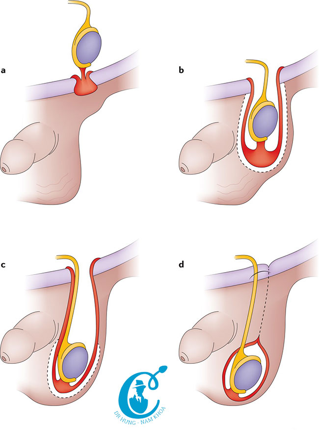 Minh họa điều trị bệnh tinh hoàn ẩn bằng phẫu thuật