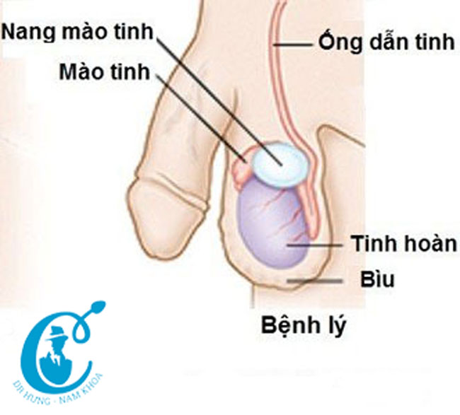 bệnh nang mào tinh hoàn