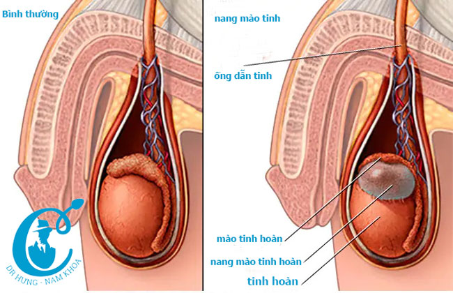 Nang mào tinh hoàn