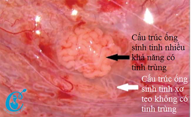 Phẫu thuật Micro-TESE